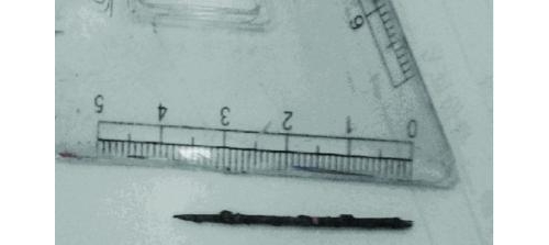 【揭秘】产妇体内一根绣花针藏20年